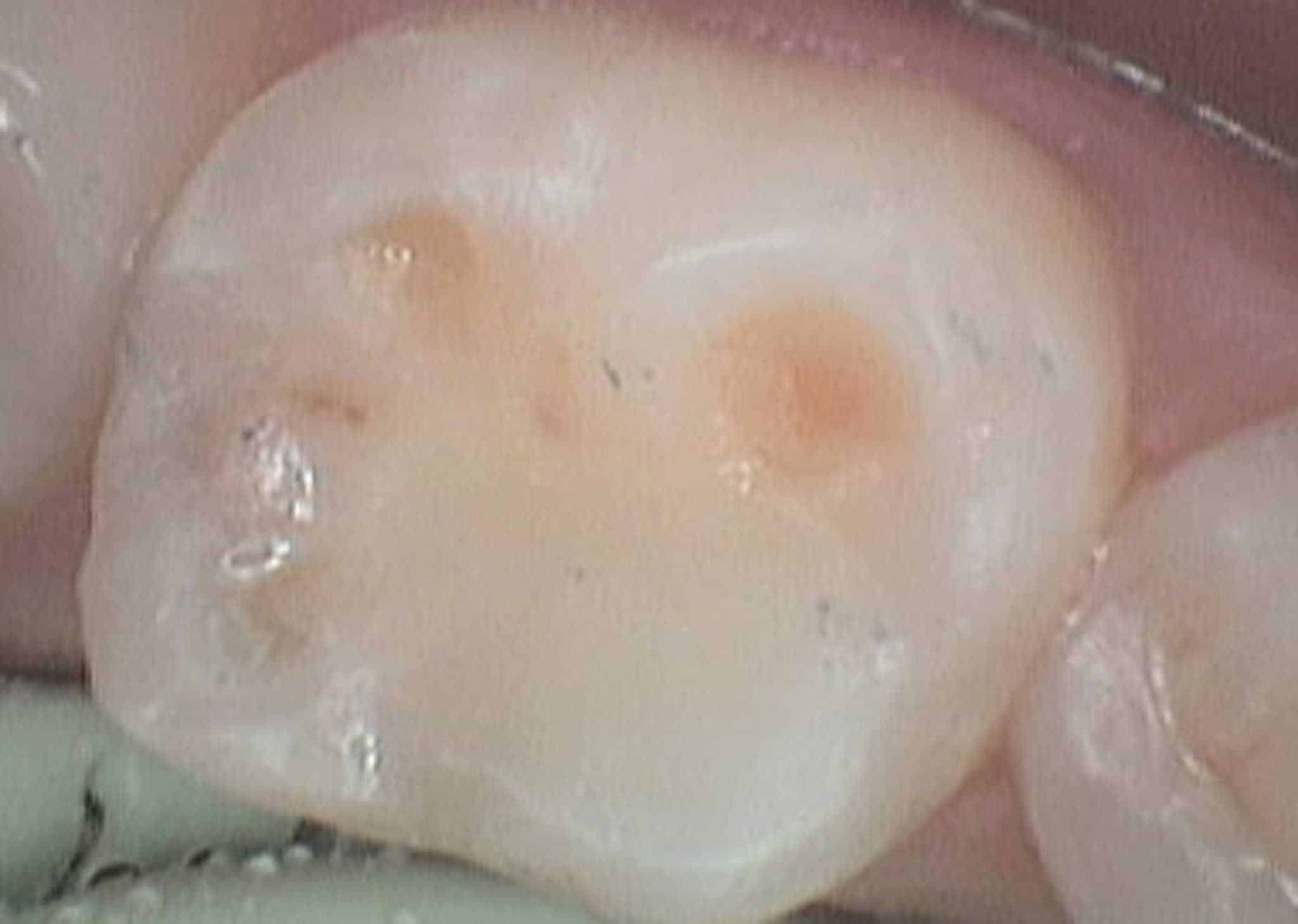 Hos Kolbotn Tannklinikk utfører tannlegevakten akutt behandling av hull i tannen – før og etter bilder fra behandling i Kolbotn, Greverud, Vinterbro og Follo