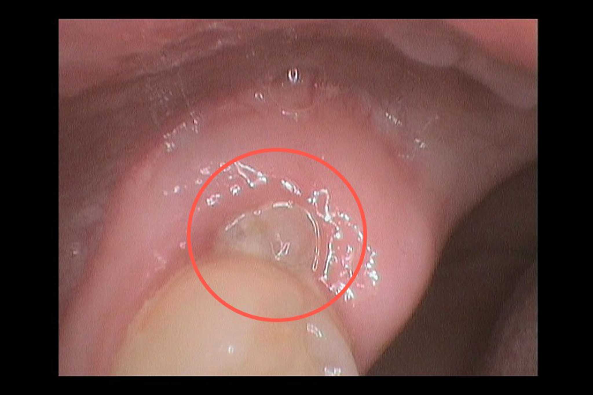 Tannlegene på Kolbotn Tannklinikk behandler infeksjon ved visdomstann – akutt tannlege i Kolbotn, Follo, Oppegård og Nordstrand.