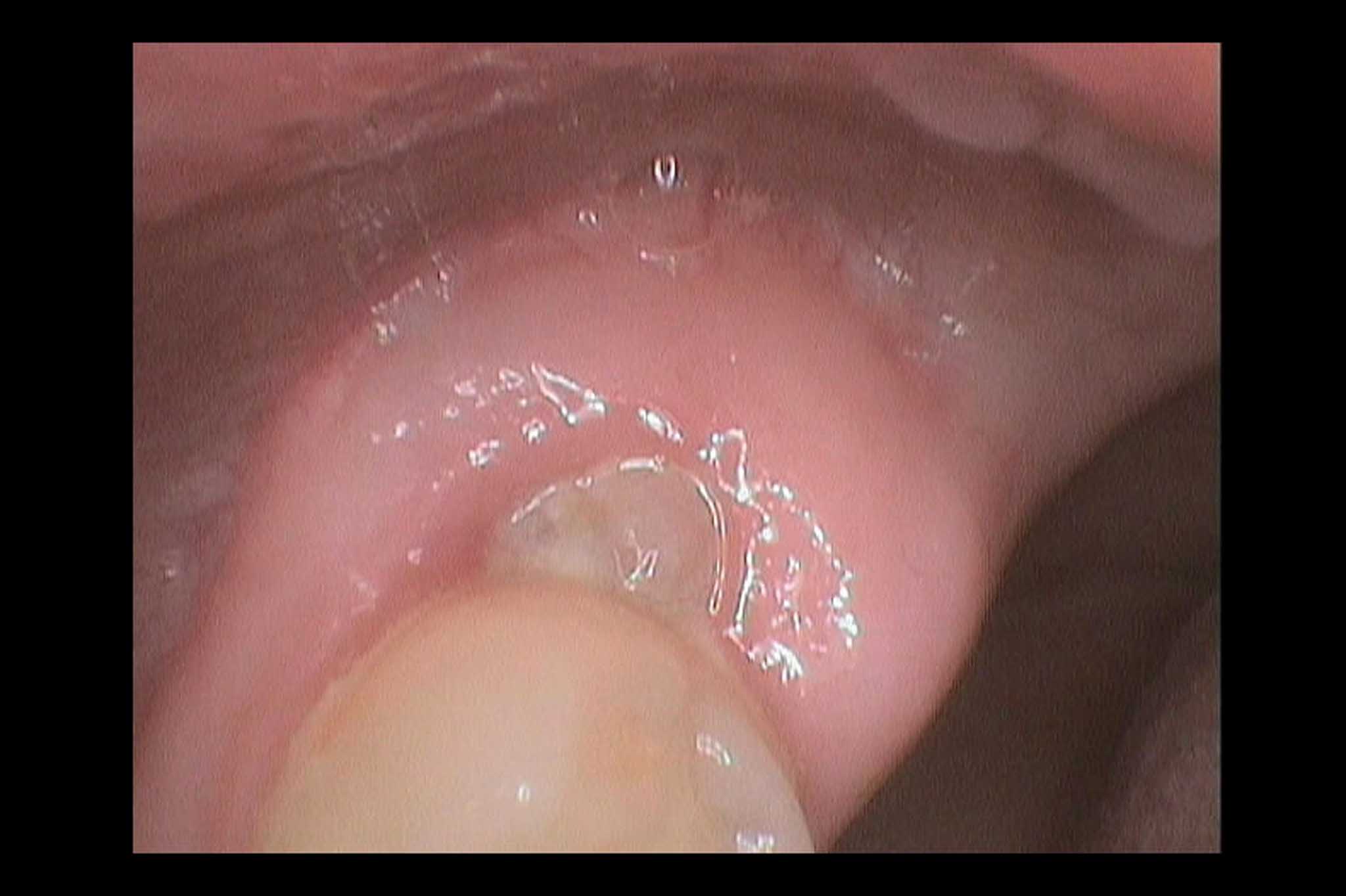 20-0-8-Kolbotn-Tannklinikk-Tannlegevakt-visdomstann-b