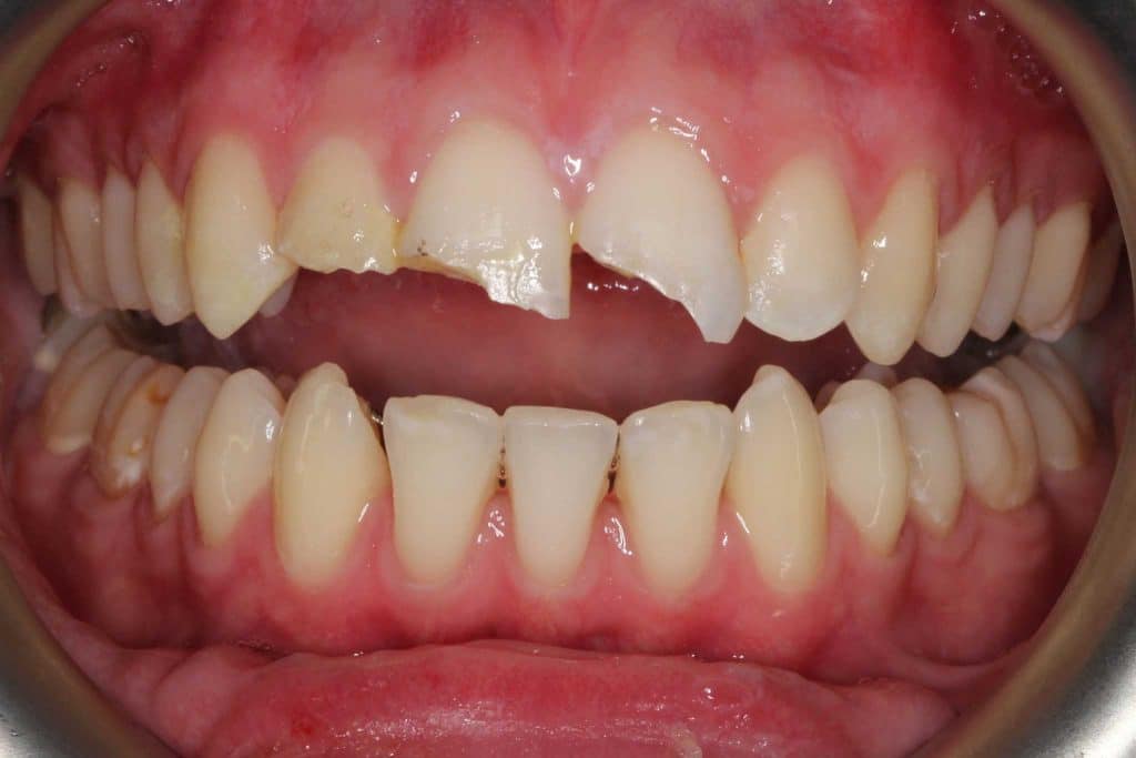 Hos Kolbotn Tannklinikk dokumenterer vi tannskader etter ulykker og traumer – tannleger i Kolbotn, Follo, Oppegård og Vinterbro tilbyr akutt behandling og oppfølging.