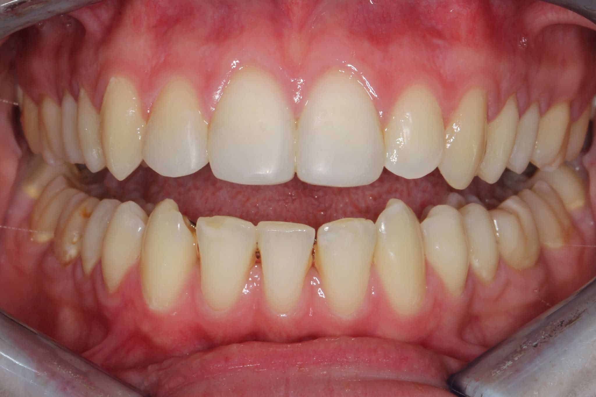 Hos Kolbotn Tannklinikk viser vi før- og etterbilder av akuttbehandling ved tannskader etter ulykke – profesjonell reparasjon med fyllingsmateriale. Behandling for pasienter i Kolbotn, Follo, Nordstrand og Holmlia.