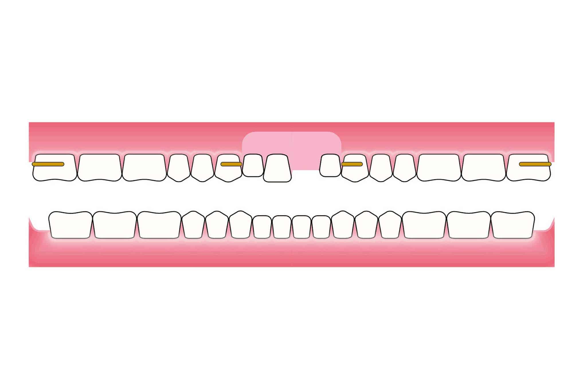 Hos Kolbotn Tannklinikk dokumenterer vi før- og etterbilder av protese med manglende tann som blir erstattet – akutt behandling i Kolbotn, Follo og Oppegård.