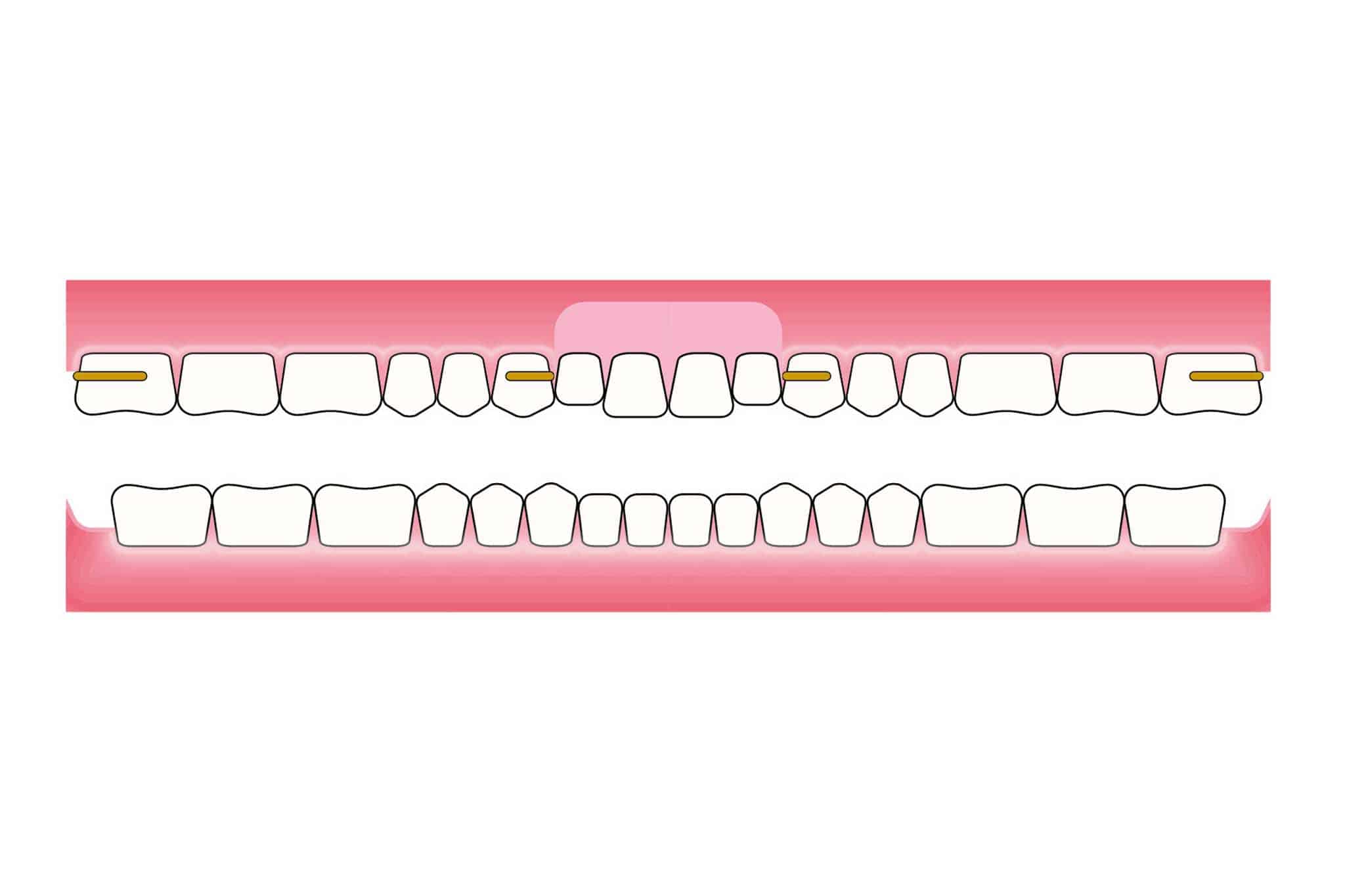 Hos Kolbotn Tannklinikk dokumenterer vi før- og etterbilder av protese med manglende tann som blir erstattet – akutt behandling i Kolbotn, Follo og Oppegård.