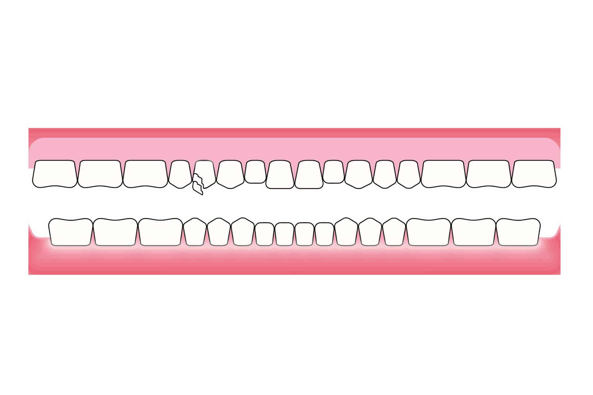 Ved Kolbotn Tannklinikk viser vi før- og etterbilder av reparasjon av frakturert protesetann – trygg proteseakutt i Kolbotn, Vinterbro og Follo.