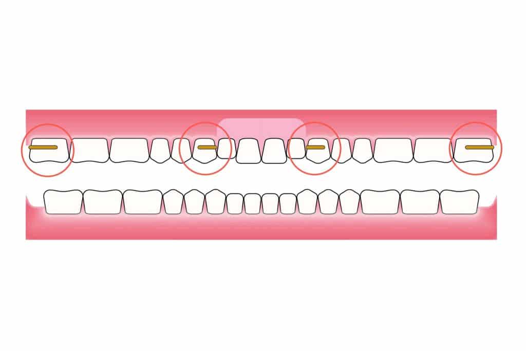 Tannlegene på Kolbotn Tannklinikk viser illustrasjon av klammere brukt til delprotese – akutt tannlege i Kolbotn, Greverud, Myrvoll og Sofiemyr.