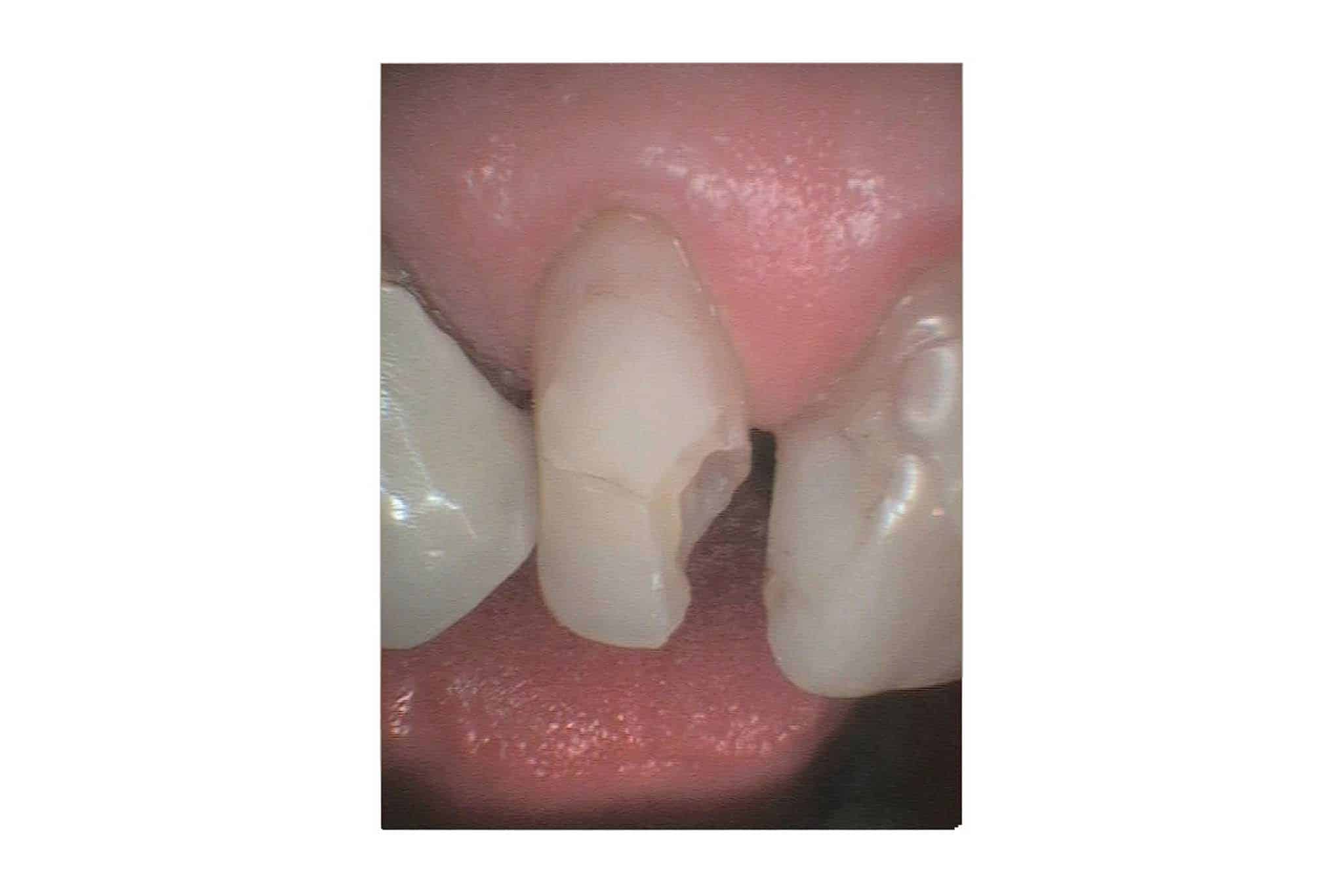 Hos Kolbotn Tannklinikk viser vi før- og etterbilder av tann med tapt fylling som ble gjenoppbygget med tannfarget fylling – akutt behandling i Kolbotn, Follo og Oppegård.