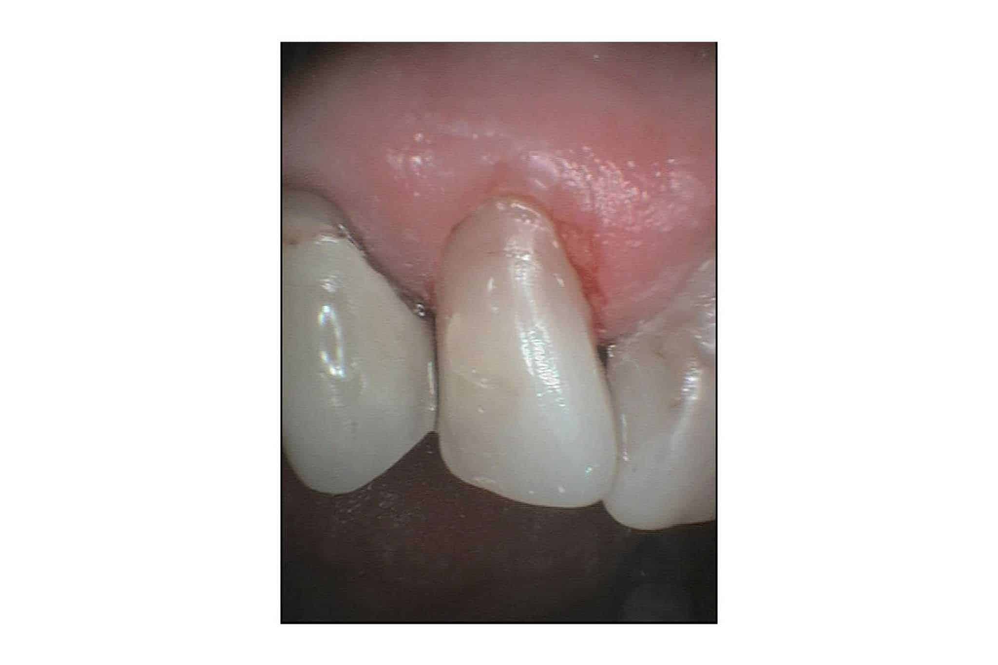 Hos Kolbotn Tannklinikk viser vi før- og etterbilder av tann med tapt fylling som ble gjenoppbygget med tannfarget fylling – akutt behandling i Kolbotn, Follo og Oppegård.