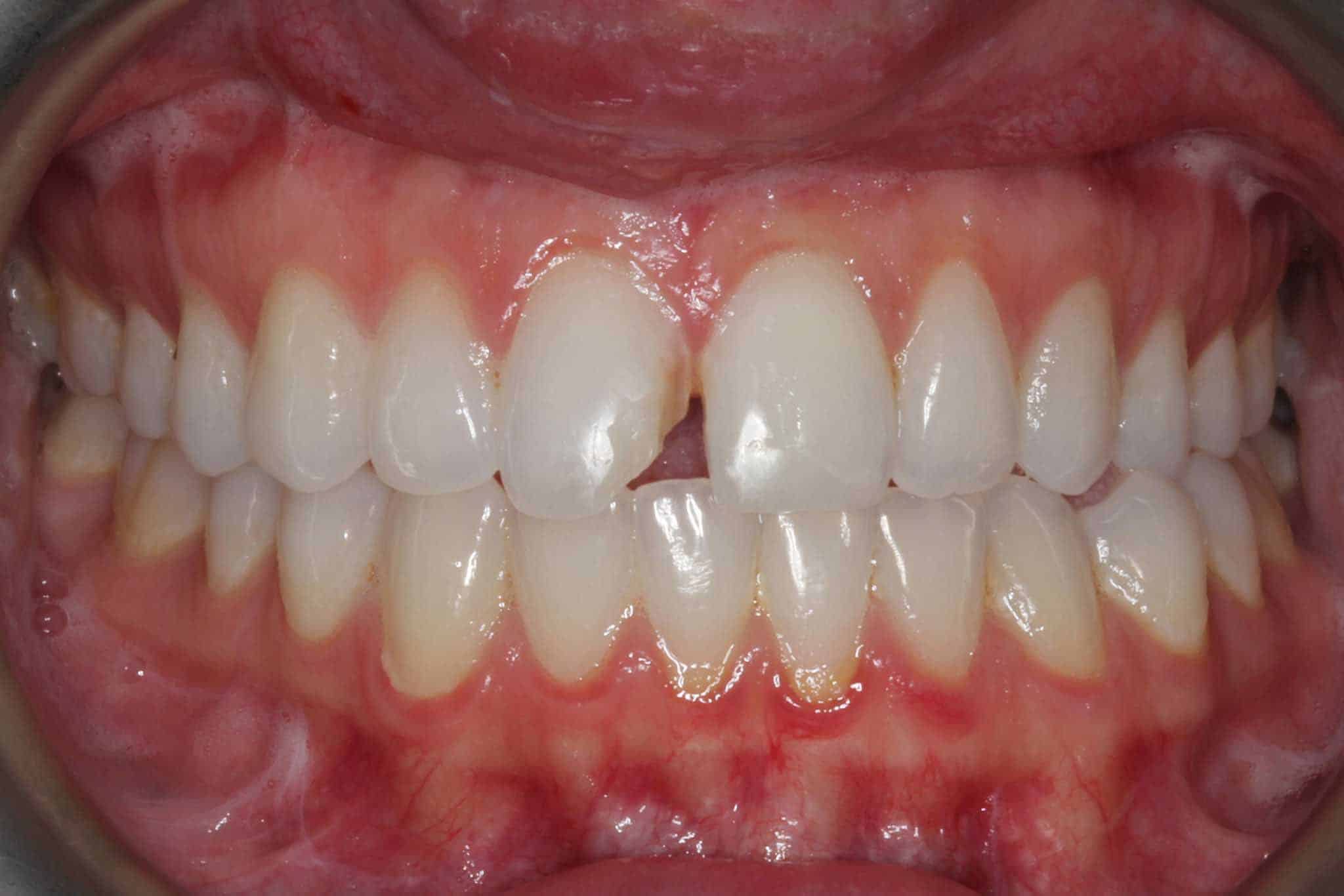 Ved Kolbotn Tannklinikk dokumenterer vi før- og etterbilder av tapt fylling som ble erstattet med fyllingsmateriale – akutt tannlege i Kolbotn, Vinterbro, Follo.