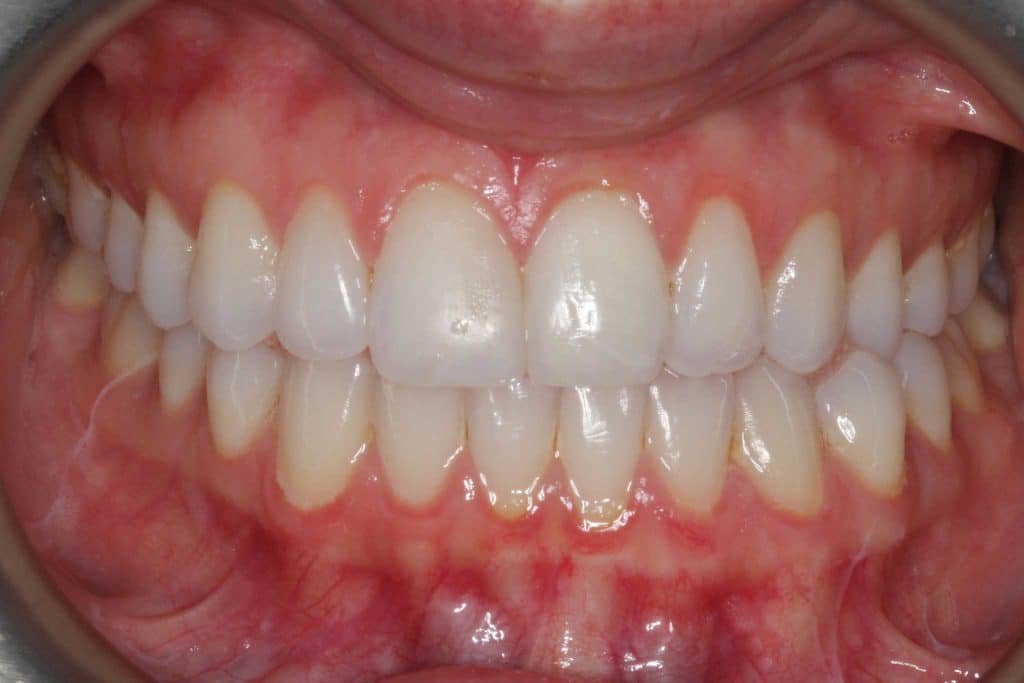 Hos Kolbotn Tannklinikk dokumenterer vi tann med tapt fylling før behandling – akutt tannlegevakt i Kolbotn, Follo, Oppegård og Vinterbro gir rask og trygg hjelp.