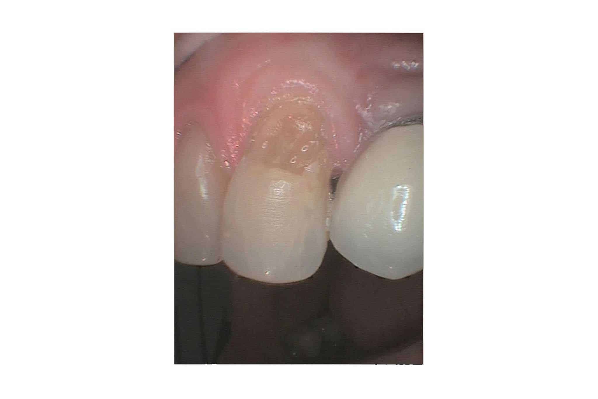 Tannlegene på Kolbotn Tannklinikk viser før- og etterbilder av tann med mistet fylling behandlet med tannfarget fyllingsmateriale – Kolbotn, Greverud, Myrvoll og Follo.