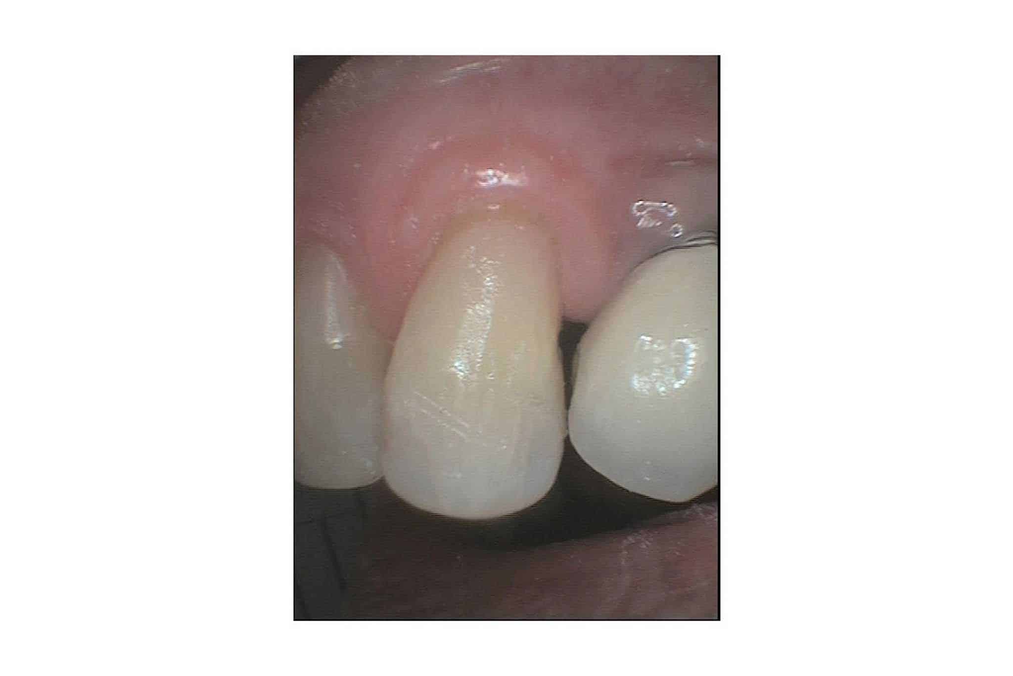 Tannlegene på Kolbotn Tannklinikk viser før- og etterbilder av tann med mistet fylling behandlet med tannfarget fyllingsmateriale – Kolbotn, Greverud, Myrvoll og Follo.