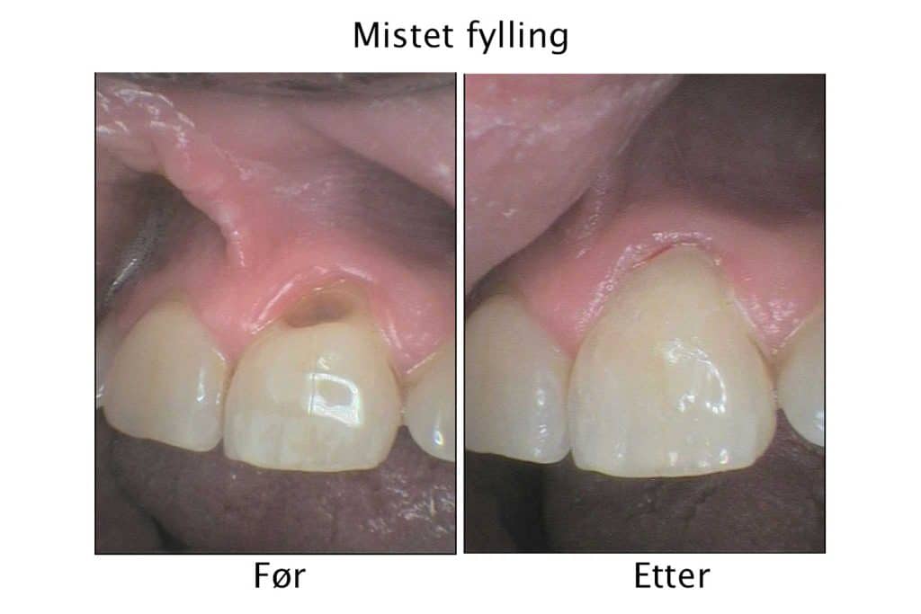 Hos Kolbotn Tannklinikk viser vi galleri av tapt fylling som er bygget opp med tannfarget fylling – akutt tannlege i Kolbotn, Follo og Oppegård.