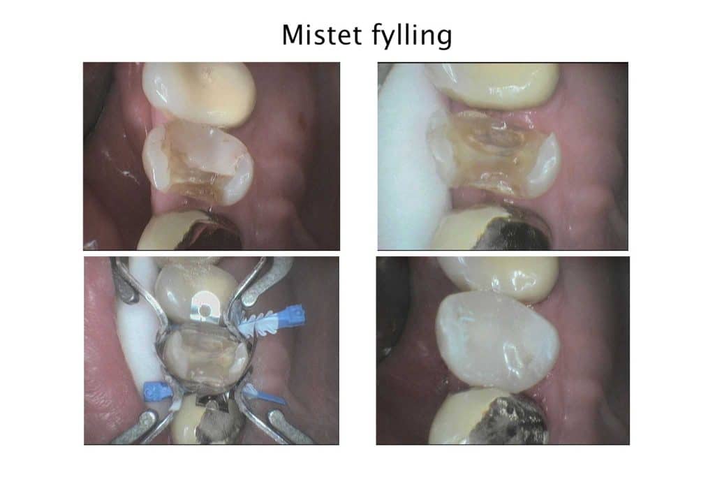 Ved Kolbotn Tannklinikk dokumenterer vi behandlingsprosessen ved mistet fylling – trygg behandling for pasienter i Kolbotn, Vinterbro, Holmlia og Nordstrand.