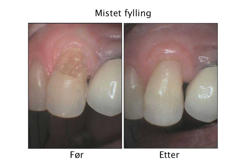 Tannlegene på Kolbotn Tannklinikk viser galleri med resultat etter behandling av tapt fylling – pasienter fra Kolbotn, Follo, Sofiemyr og Greverud.