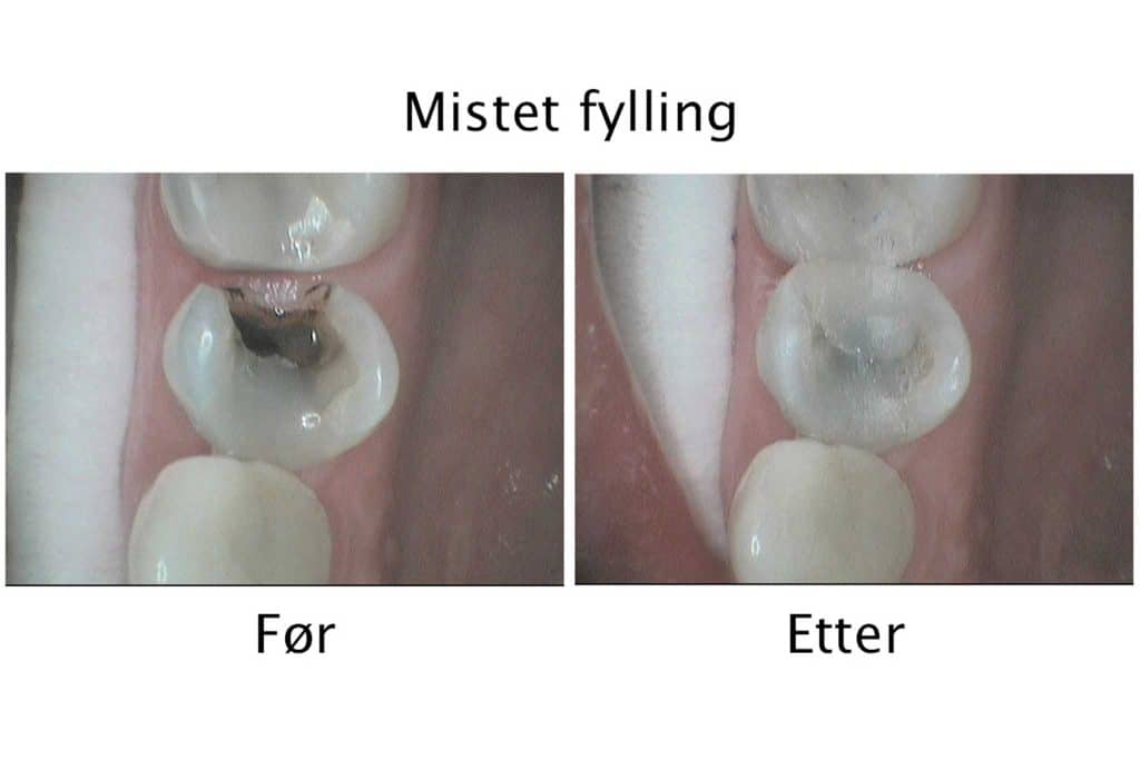 Hos Kolbotn Tannklinikk dokumenterer vi behandling av tapt fylling i galleri – akutt tannlege i Kolbotn, Oppegård, Myrvoll og Follo.