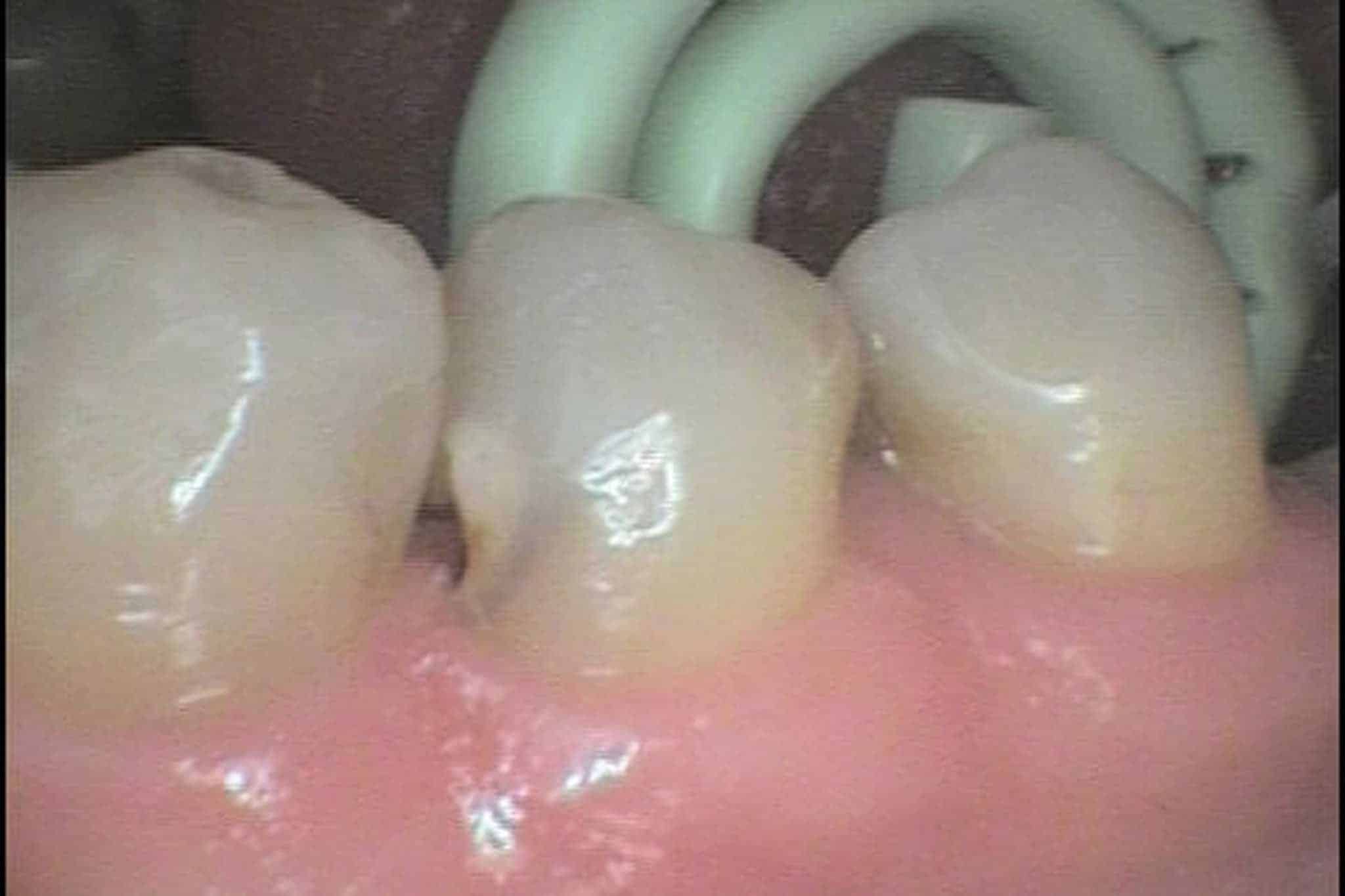 Hos Kolbotn Tannklinikk dokumenterer vi før- og etterbilder av hull i tennene reparert med tannfarget fylling – akutt tannlege i Kolbotn, Follo og Oppegård.