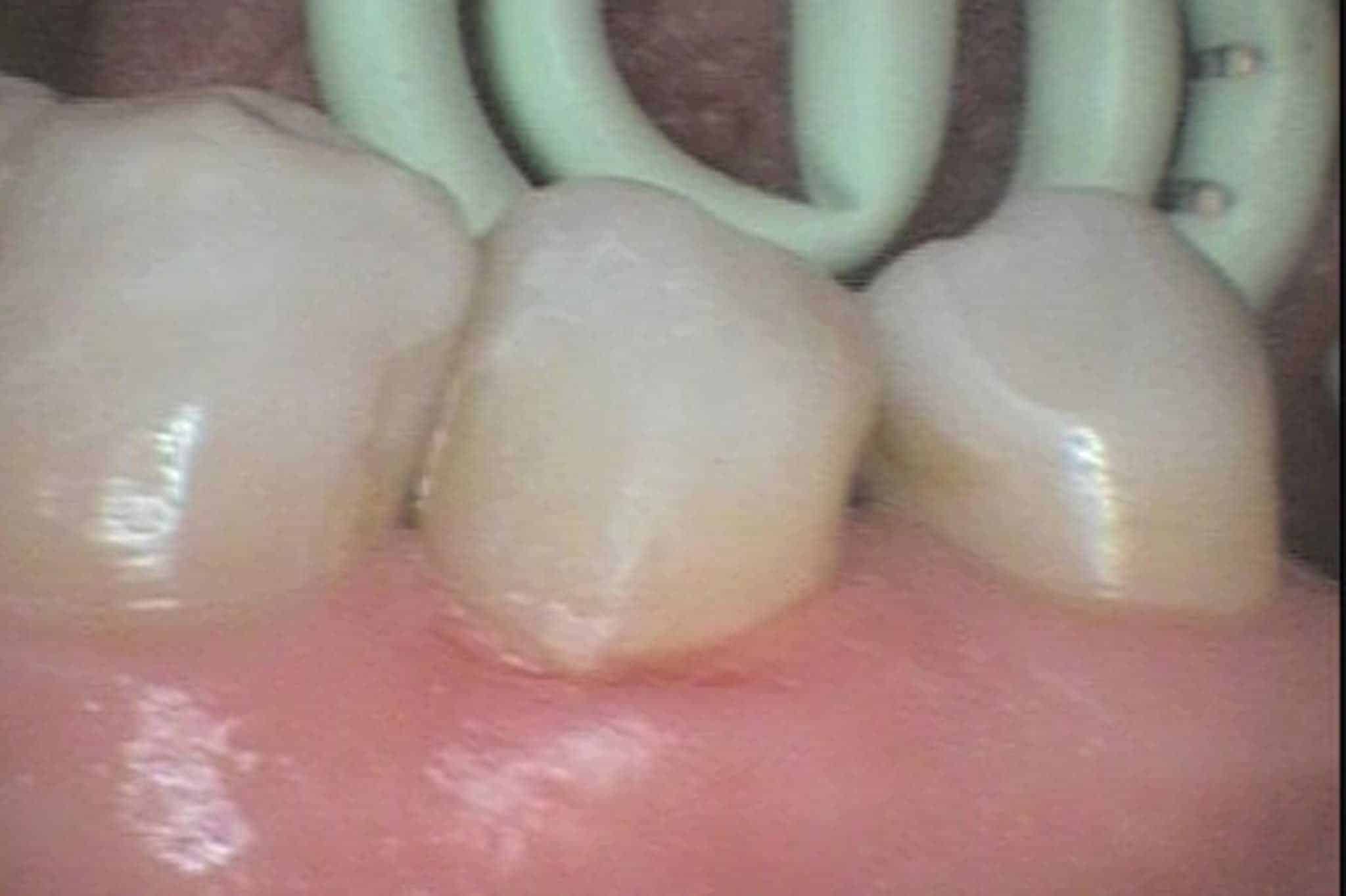 Hos Kolbotn Tannklinikk dokumenterer vi før- og etterbilder av hull i tennene reparert med tannfarget fylling – akutt tannlege i Kolbotn, Follo og Oppegård.