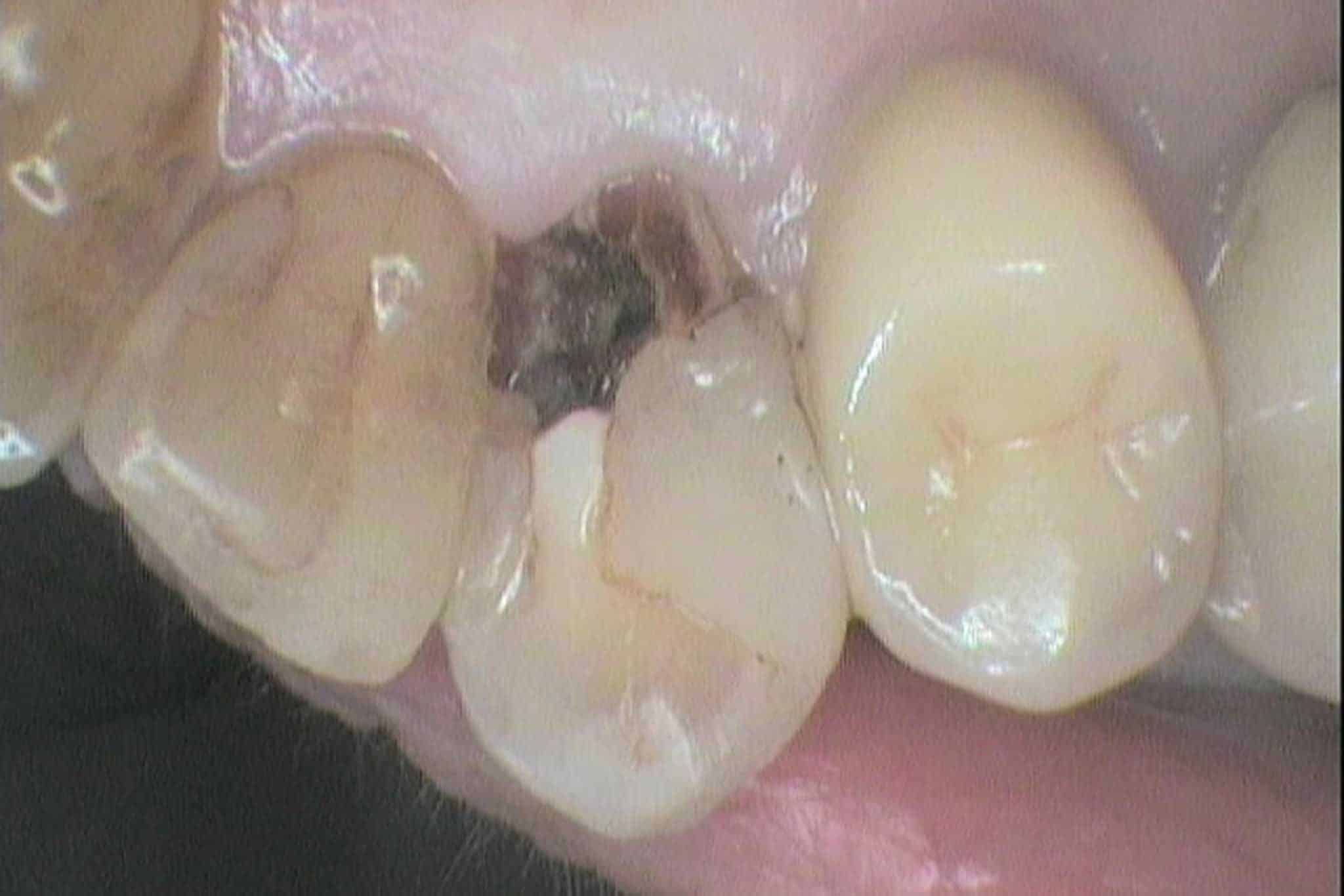 Ved Kolbotn Tannklinikk viser vi før- og etterbilder av dypt hull i tann behandlet med fyllingsmateriale – Kolbotn, Vinterbro, Greverud og Follo.