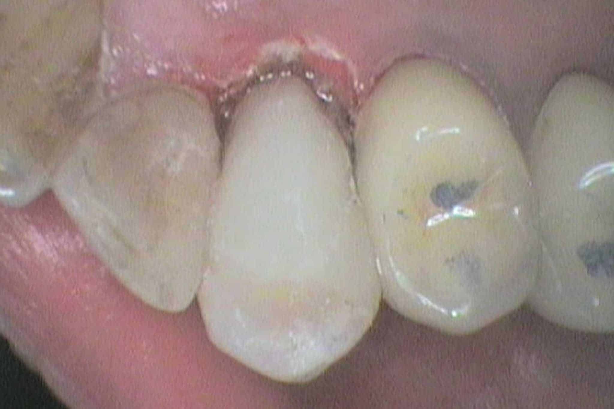 Ved Kolbotn Tannklinikk viser vi før- og etterbilder av dypt hull i tann behandlet med fyllingsmateriale – Kolbotn, Vinterbro, Greverud og Follo.