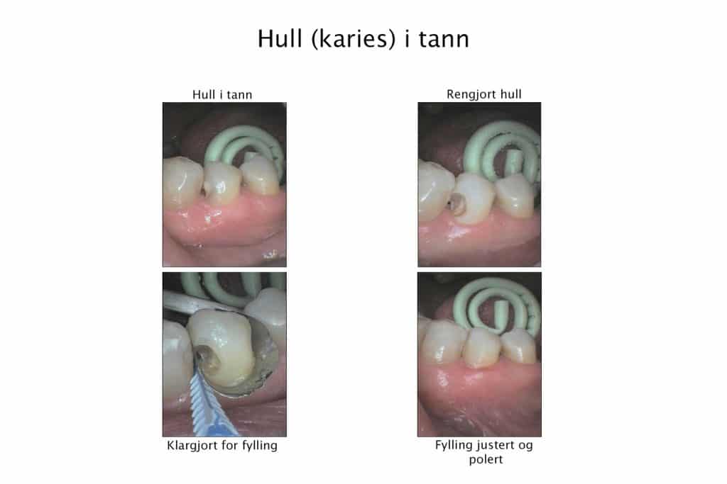 Hos Kolbotn Tannklinikk dokumenterer vi behandlingsprosessen av karies med fyllingsmateriale – tannlege i Kolbotn, Follo, Oppegård og Myrvoll.