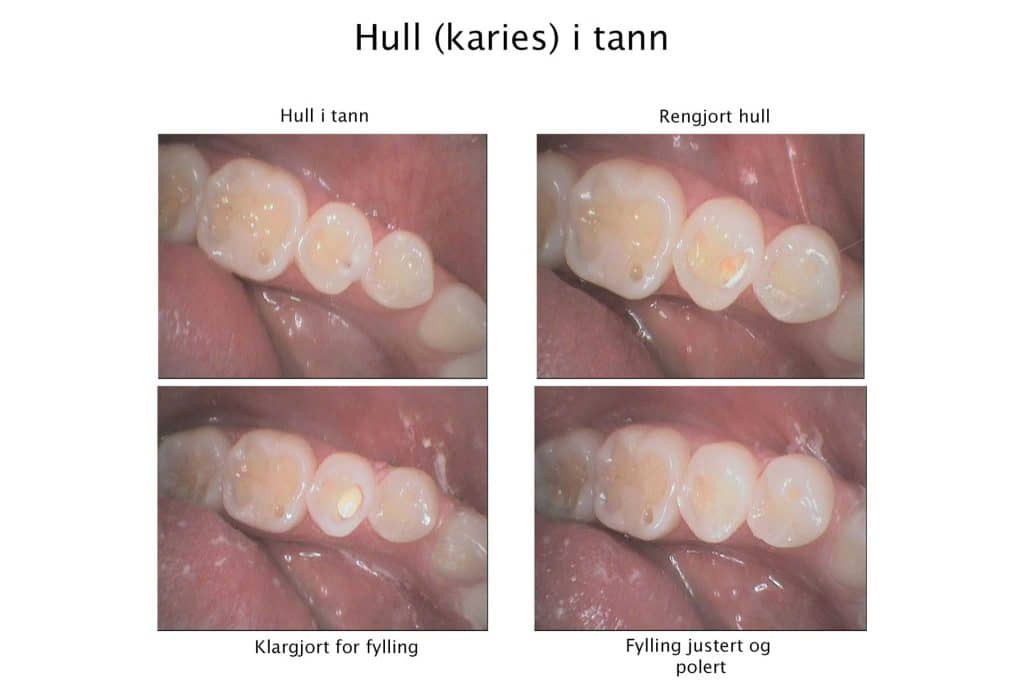 Ved Kolbotn Tannklinikk viser vi behandlingsforløpet ved reparasjon av hull i tennene – Kolbotn, Vinterbro, Holmlia og Nordstrand.