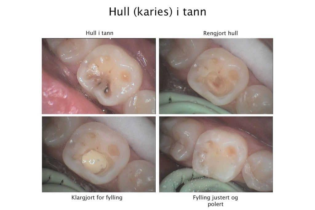 Tannlegene på Kolbotn Tannklinikk dokumenterer galleri fra behandling av dype hull i tennene – Kolbotn, Sofiemyr, Greverud og Follo.