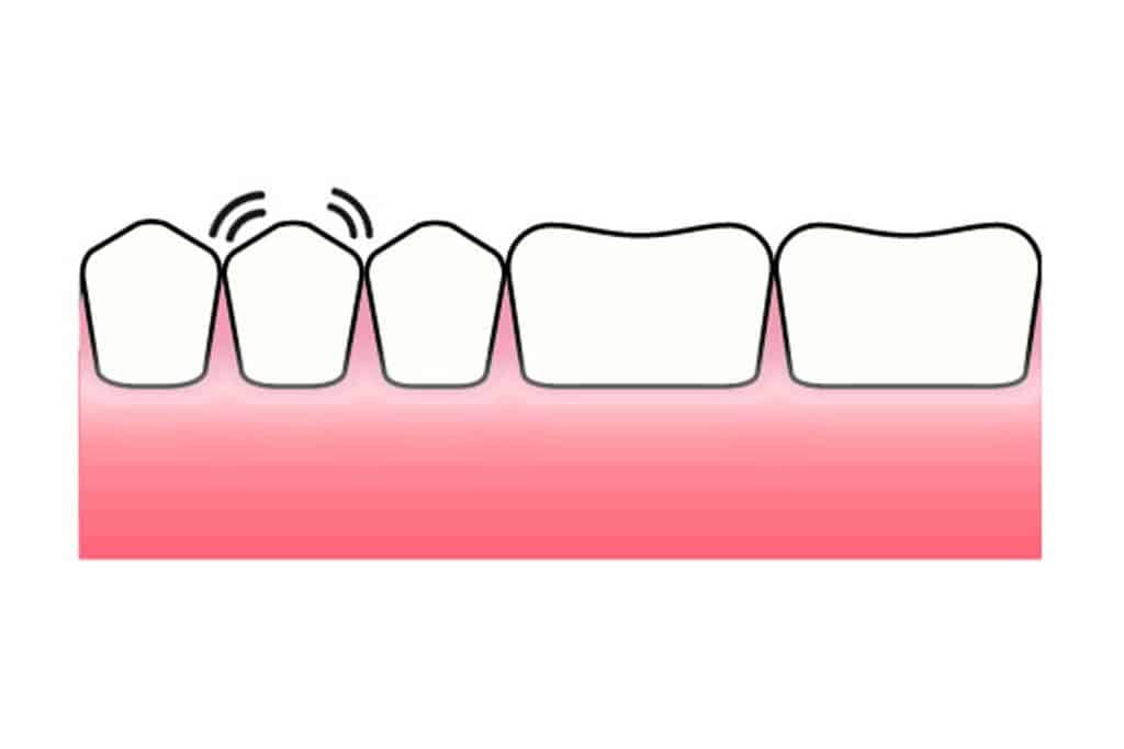 Hos Kolbotn Tannklinikk dokumenterer vi hvordan en løs tann ser ut – akutt behandling hos tannlege i Kolbotn, Follo, Oppegård og Vinterbro.