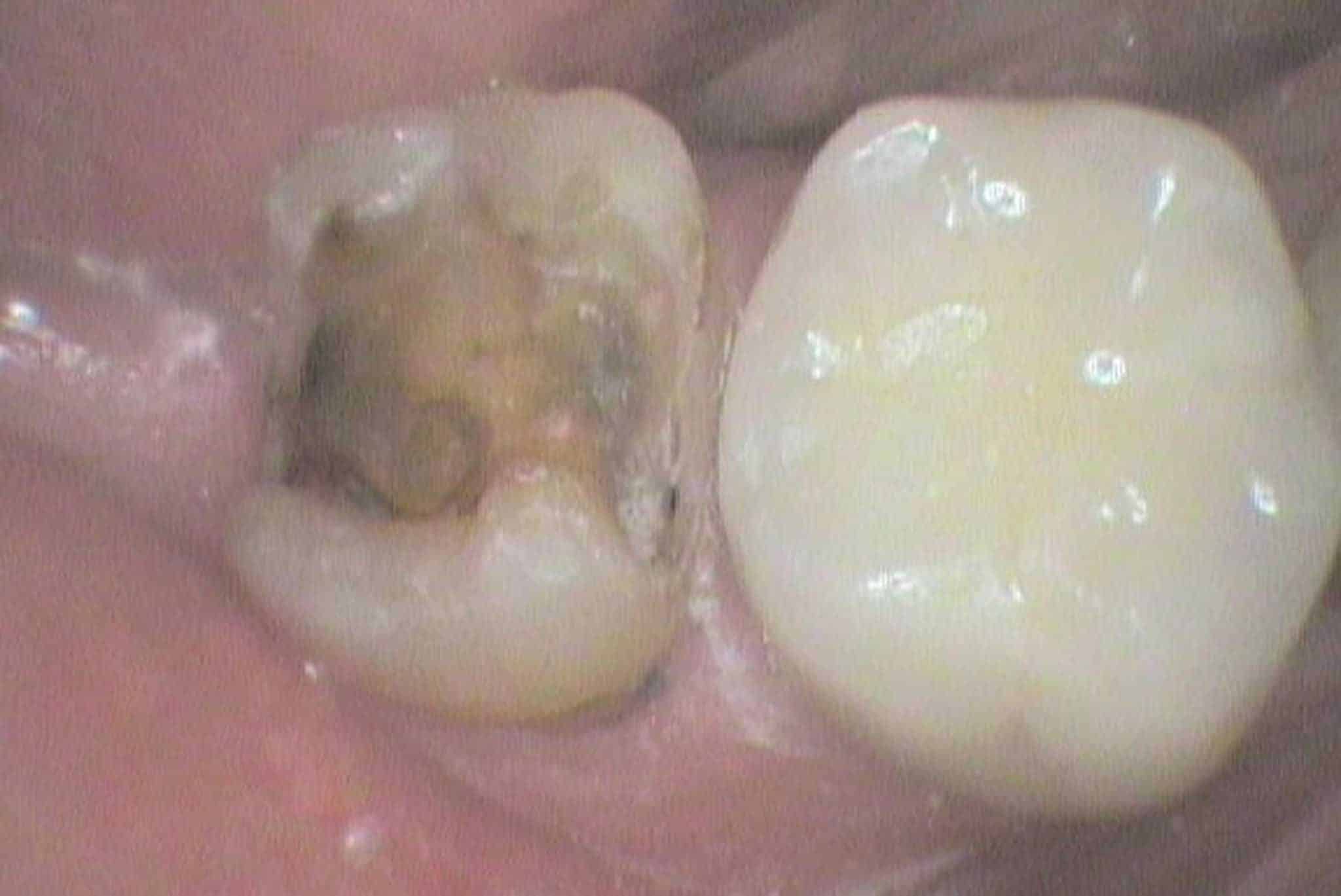 Hos Kolbotn Tannklinikk dokumenterer vi før- og etterbilder av løs krone som er festet igjen – akutt tannlegevakt i Kolbotn, Follo og Oppegård.