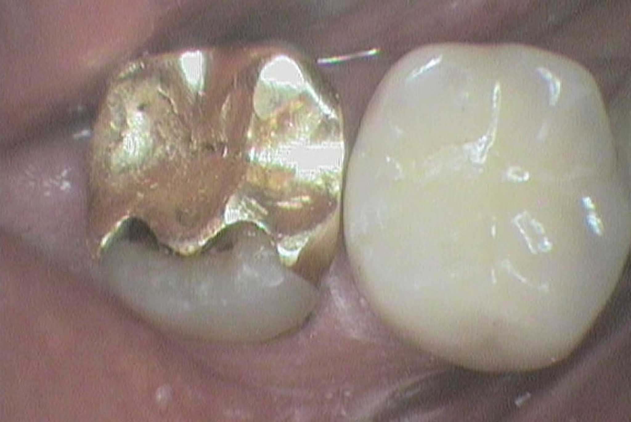 Hos Kolbotn Tannklinikk dokumenterer vi før- og etterbilder av løs krone som er festet igjen – akutt tannlegevakt i Kolbotn, Follo og Oppegård.