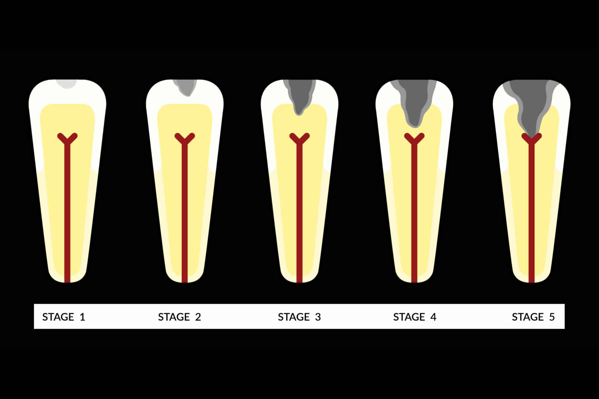 Hos Kolbotn Tannklinikk brukes kariesgradering for å vurdere behandling – pedagogisk illustrasjon for pasienter i Kolbotn, Follo og Oppegård.