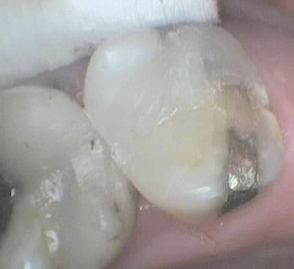 Før- og etterbilde: Hos Kolbotn Tannklinikk erstatter tannlegene gamle amalgamfyllinger med tannfargede fyllinger – naturlig og trygt resultat for pasienter i Kolbotn, Follo, Vinterbro, Nordstrand og Holmlia.