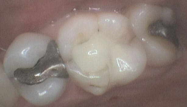 På Kolbotn Tannklinikk brukes krone for å reparere tannskader – trygg behandling i Kolbotn, Oppegård og Vinterbro.