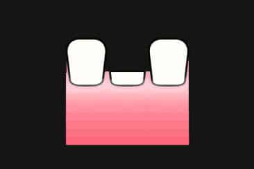 Hos Kolbotn Tannklinikk utføres oppbygging med stiftkonus og krone – avansert behandling i Kolbotn, Myrvoll og Follo.