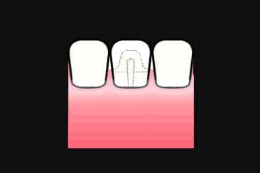 Hos Kolbotn Tannklinikk utføres oppbygging med stiftkonus og krone – avansert behandling i Kolbotn, Myrvoll og Follo.