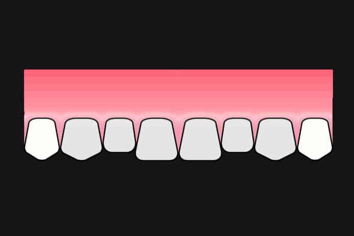 Ved Kolbotn Tannklinikk brukes fasetter for å forbedre utseendet på fortenner – moderne tannklinikk i Kolbotn, Vinterbro og Nordstrand.