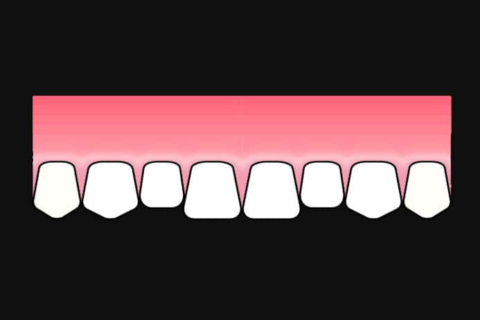Ved Kolbotn Tannklinikk brukes fasetter for å forbedre utseendet på fortenner – moderne tannklinikk i Kolbotn, Vinterbro og Nordstrand.
