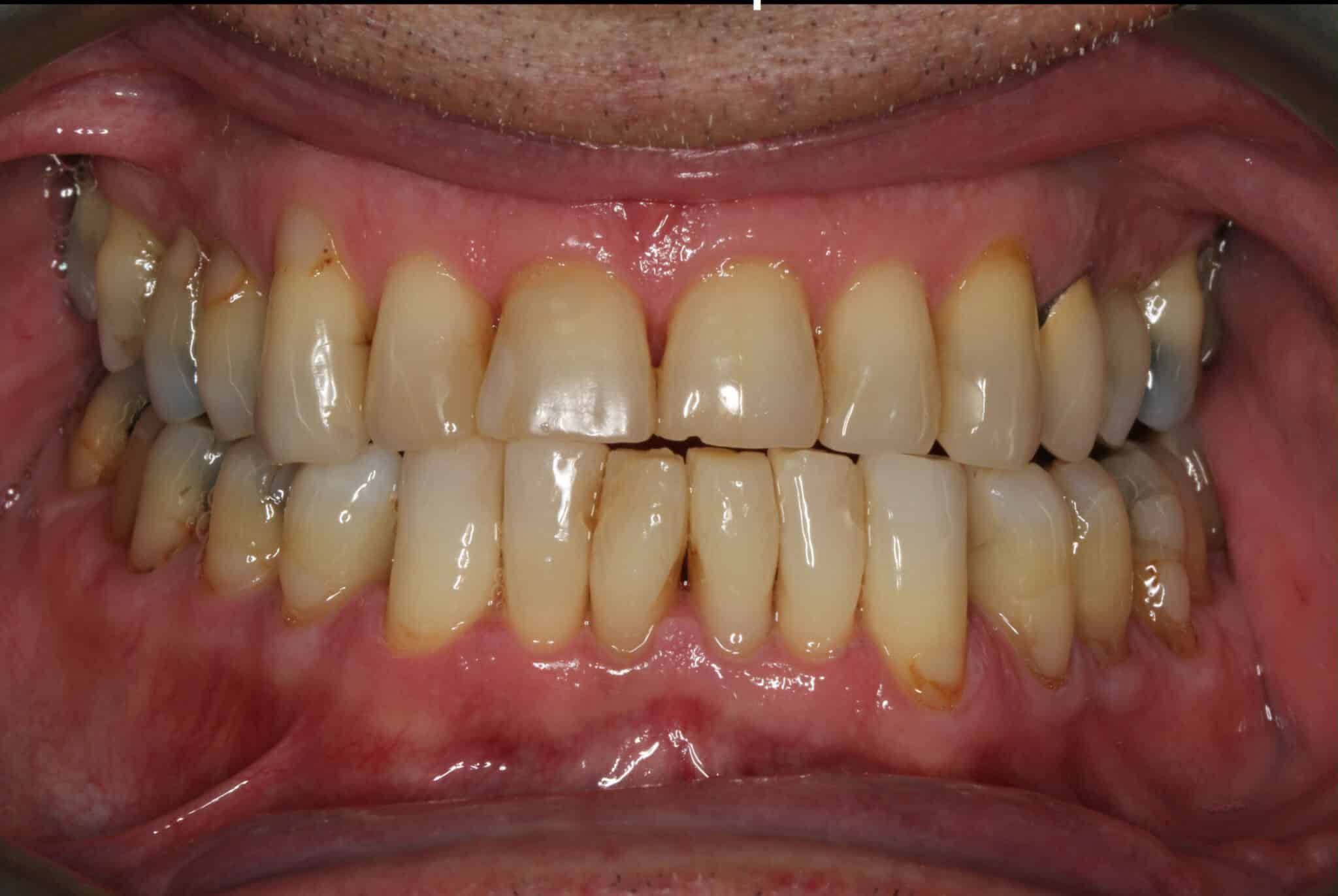 Før- og etterbilde: Hos Kolbotn Tannklinikk behandles seks fortenner i overkjeven med fasetter/laminat – naturlig estetisk resultat for pasienter i Kolbotn, Follo, Vinterbro, Holmlia og Nordstrand.