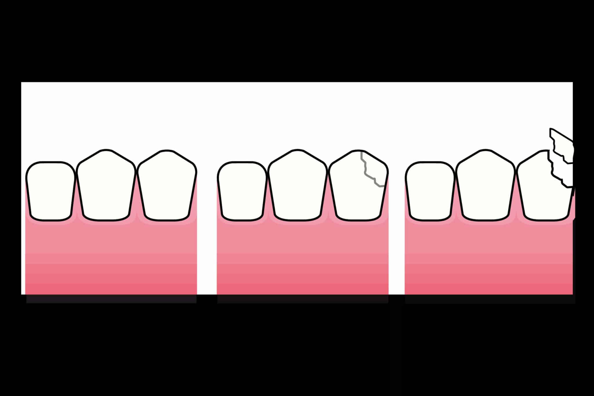 Ved Kolbotn Tannklinikk demonstreres hvordan tannfraktur vurderes ved valg av tannfarget fylling – informasjon for pasienter i Kolbotn, Oppegård og Nordstrand.