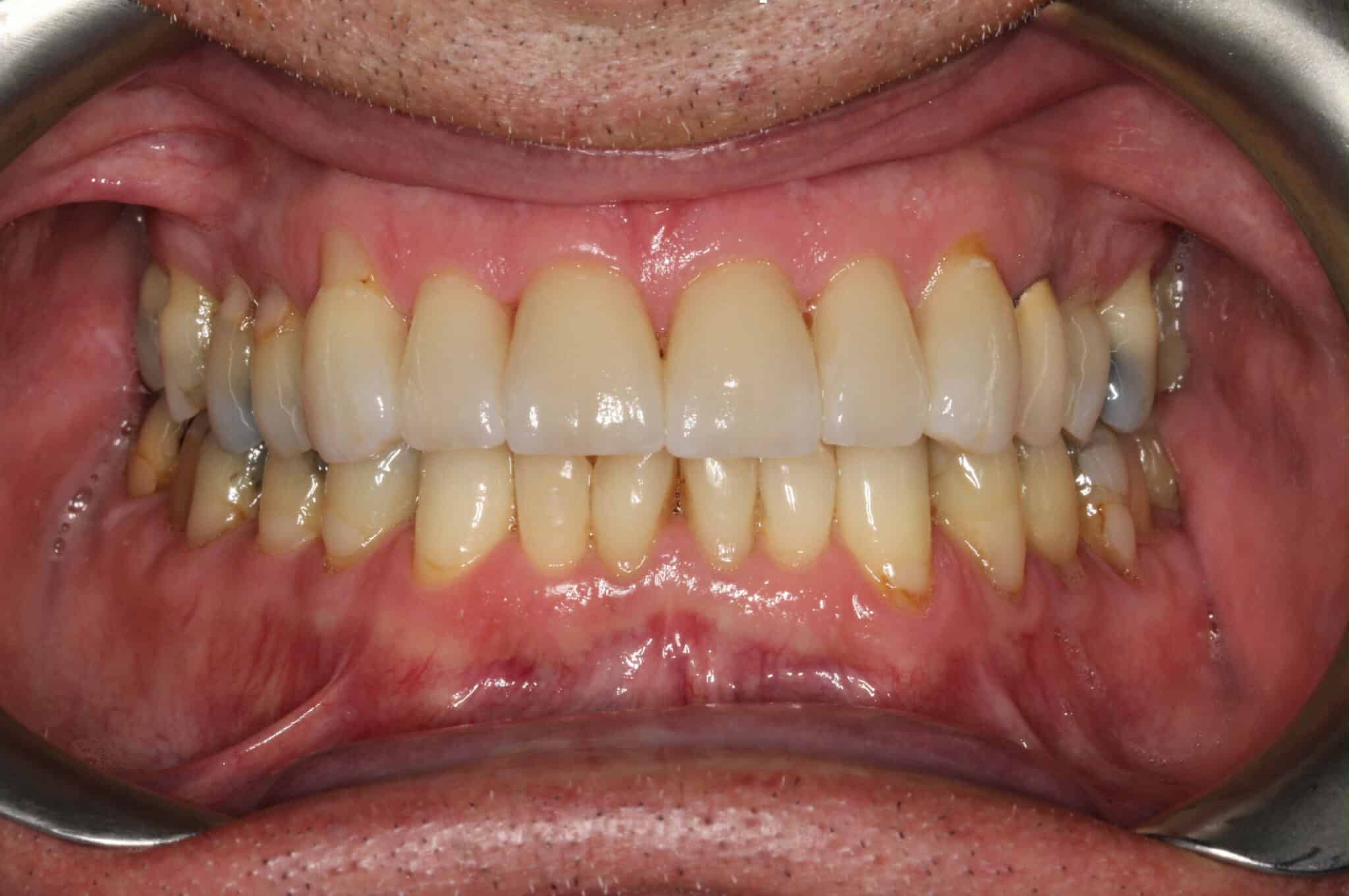 Hos Kolbotn Tannklinikk bygges fortenner opp med fasetter/laminat – estetisk tannbehandling i Kolbotn, Holmlia og Sofiemyr.