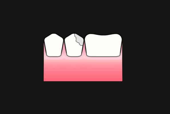 Hos Kolbotn Tannklinikk brukes midlertidig fylling for å beskytte en frakturert tann – trygg behandling i Kolbotn, Follo og Holmlia.