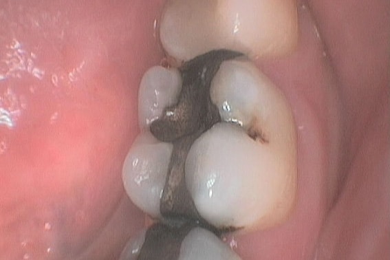 På Kolbotn Tannklinikk legges midlertidige fyllinger for å beskytte tyggeflater – trygg tannlege i Kolbotn, Oppegård og Myrvoll.