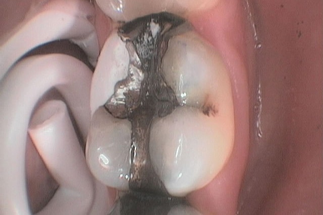 På Kolbotn Tannklinikk legges midlertidige fyllinger for å beskytte tyggeflater – trygg tannlege i Kolbotn, Oppegård og Myrvoll.