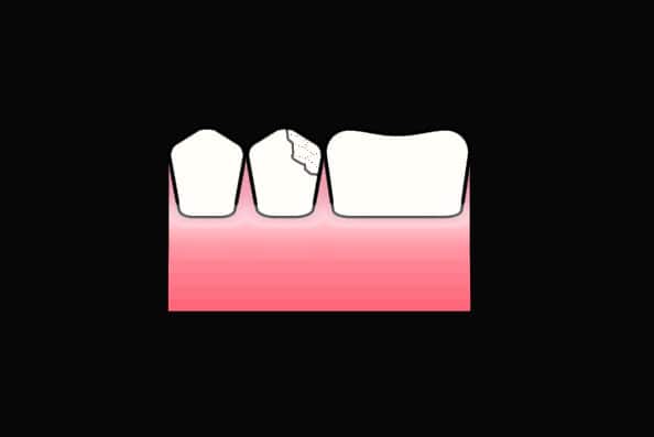 Ved Kolbotn Tannklinikk gjenoppbygges tenner med tannfarget fylling – naturlig resultat i Kolbotn, Vinterbro og Sofiemyr.