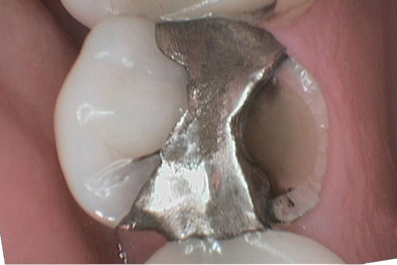 Frakturert liten jeksel bygd opp med midlertidig fylling.