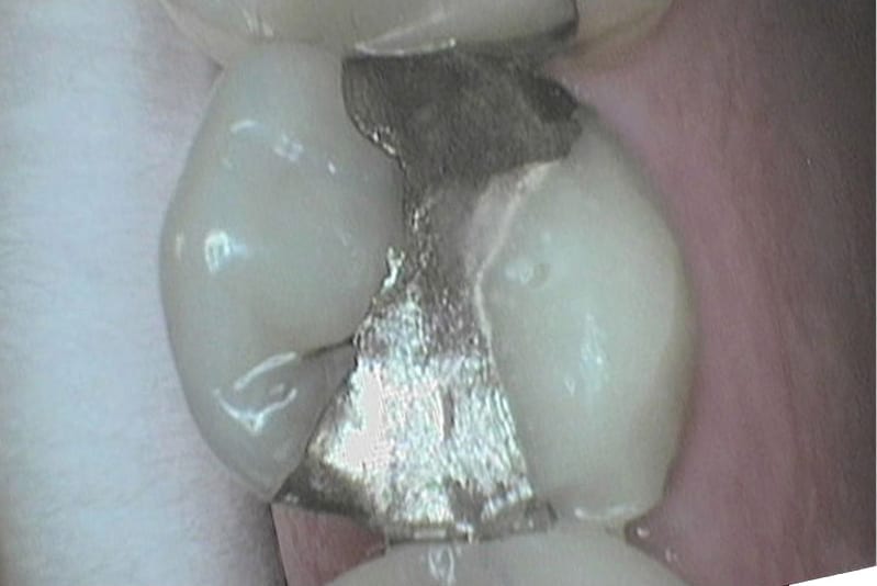 Ved Kolbotn Tannklinikk legges midlertidig fylling på en frakturert jeksel – behandling i Kolbotn, Follo, Holmlia og Nordstrand.