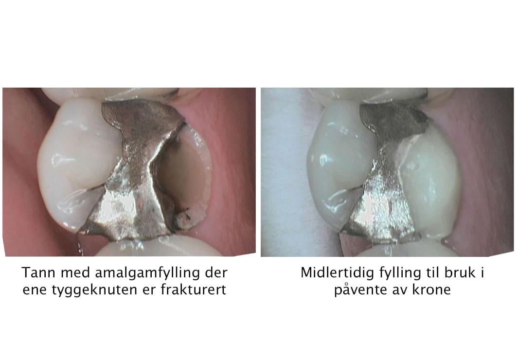 Galleri: Hos Kolbotn Tannklinikk gjenoppbygger tannlegene små jeksler med midlertidige fyllinger – moderne tannklinikk i Kolbotn, Vinterbro, Myrvoll og Sofiemyr.