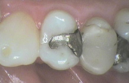 Hos Kolbotn Tannklinikk ser tannlegene en tann med gammel amalgamfylling – informasjon til pasienter i Kolbotn, Vinterbro og Follo.