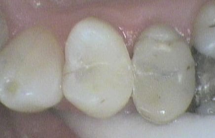 På Kolbotn Tannklinikk vurderer tannlegene gamle amalgamfyllinger som kan skiftes ut – pasienter i Kolbotn, Oppegård og Holmlia.