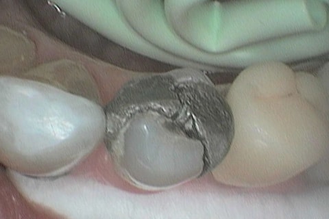 På Kolbotn Tannklinikk bygges tannen opp med tannfarget fylling for et naturlig smil – behandling i Kolbotn, Vinterbro og Holmlia.