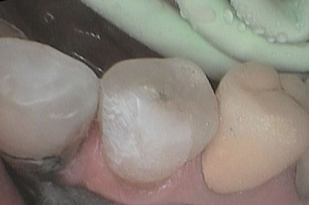 På Kolbotn Tannklinikk bygges tannen opp med tannfarget fylling for et naturlig smil – behandling i Kolbotn, Vinterbro og Holmlia.